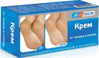 До и после крем от трещин в ступнях 150мл N1